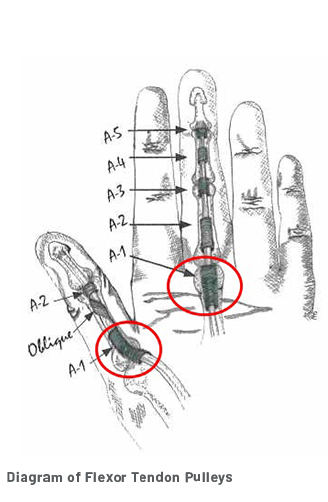 A diagram of a hand showing all of the flexor tendon pulleys