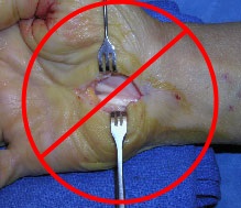 A surgical image of a wrist split open and hoisted with surgical forks