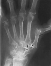X-ray depicting swan neck deformity.