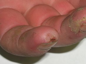 An image of fingers that are damaged and crusty