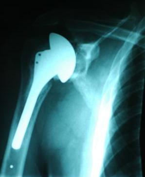 Shoulder X-ray to check for arthritis