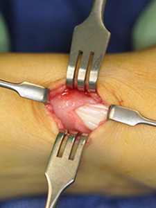 A surgical opening where the foreskin of a knee is peeled back revealing internal flesh