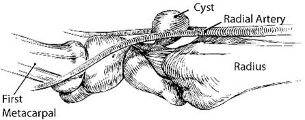 A diagram of where a cyst can take place in the wrist