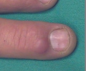 A Mucous Cyst jetting out of the top of a patient finger