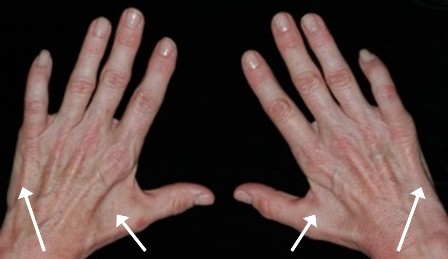 An image of two hands where arrows show intended areas within the hand