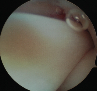 An image of a Normal Biceps Tendon