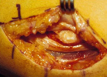 An arm cubital that is sliced open as forks hold the exterior flesh agape and open for surgery