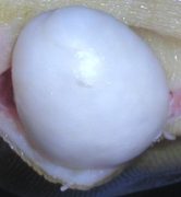 A gigantic white blob cyst removed from a patient