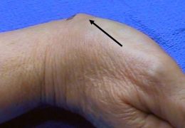 An image of a hand where the arrow is pointing to the ganglion at the base of the thumb