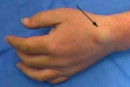A Ganlia Cyst forming a large bulge near the wrist