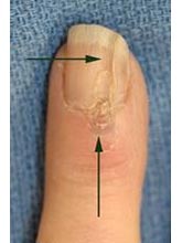 Deep Trough in Nail