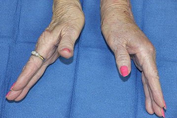 woman's hands with arthritis in wrist