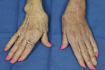 woman's hands effected by arthritis
