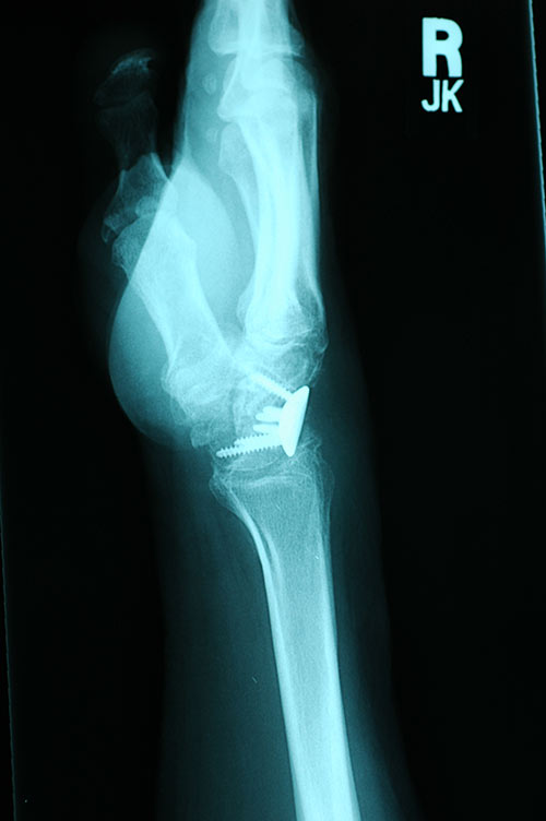 lat x-ray limited fusion wrist