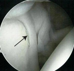 xray of shoulder arrow pointing to normal labrum