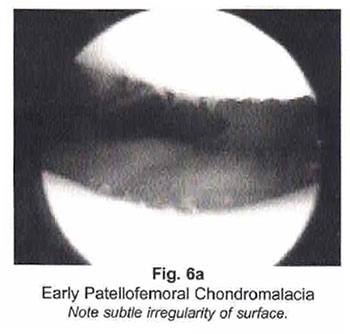 Figure 6a - Early Patellofemoral Chondromalacia