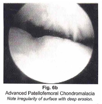 Figure 6b-Advanced Patellofemoral Chondromalacia