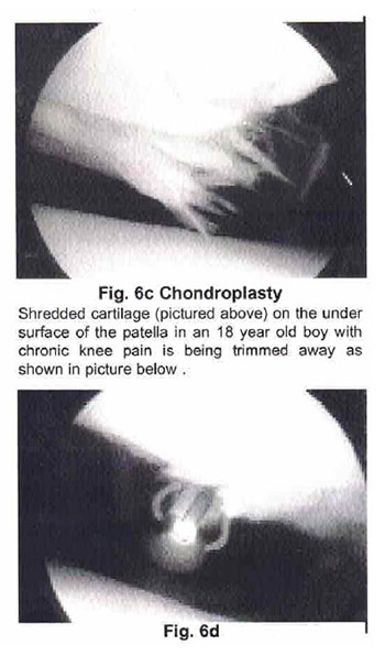 Figure 6c-d - Shredded cartilage pictured on the under surface of the patella in an 18 year old boy with chronic knee pain is being trimmed away as shown in bottom photo