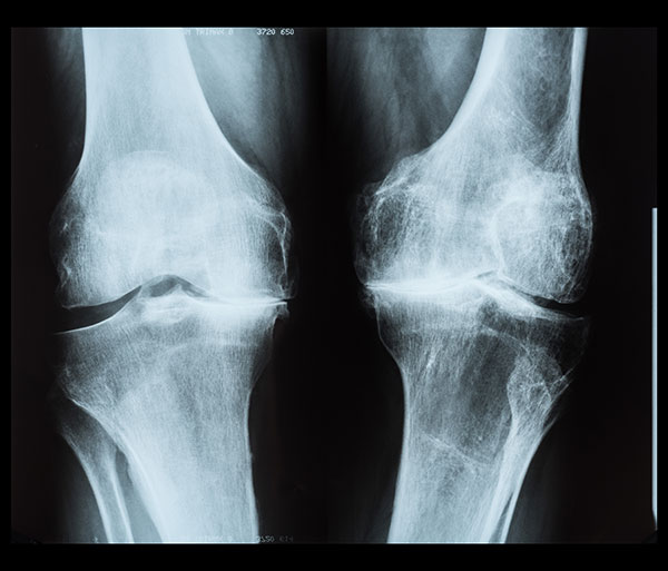 x-ray of the knee